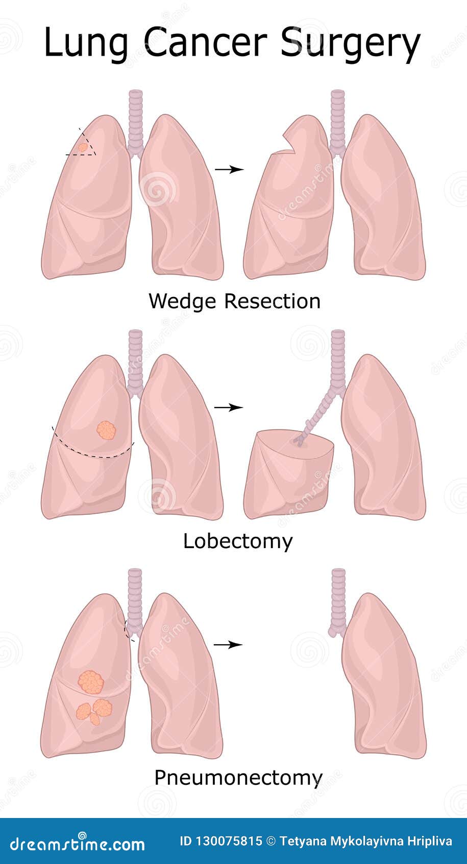 Lobectomy Cartoons, Illustrations & Vector Stock Images - 15 Pictures ...