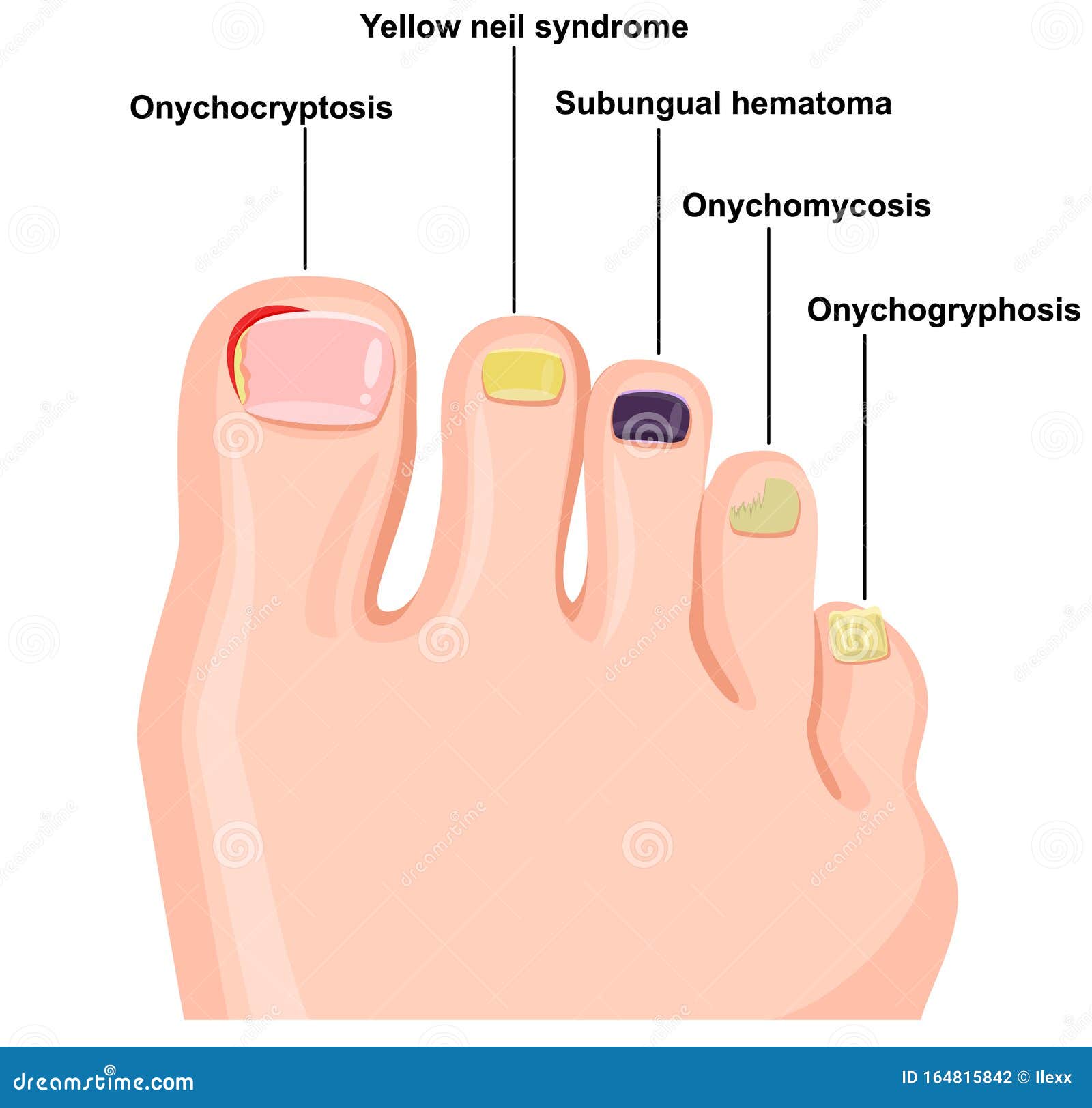 କଣ ନଖା ବା ନଖ ଭାଙ୍ଗିବାକୁ ନେଇ ଚିନ୍ତିତ କି ? ପଢ଼ନ୍ତୁ ପୂରା ଖବର... - Nail  diseases chart: Pictures, symptoms, and treatments
