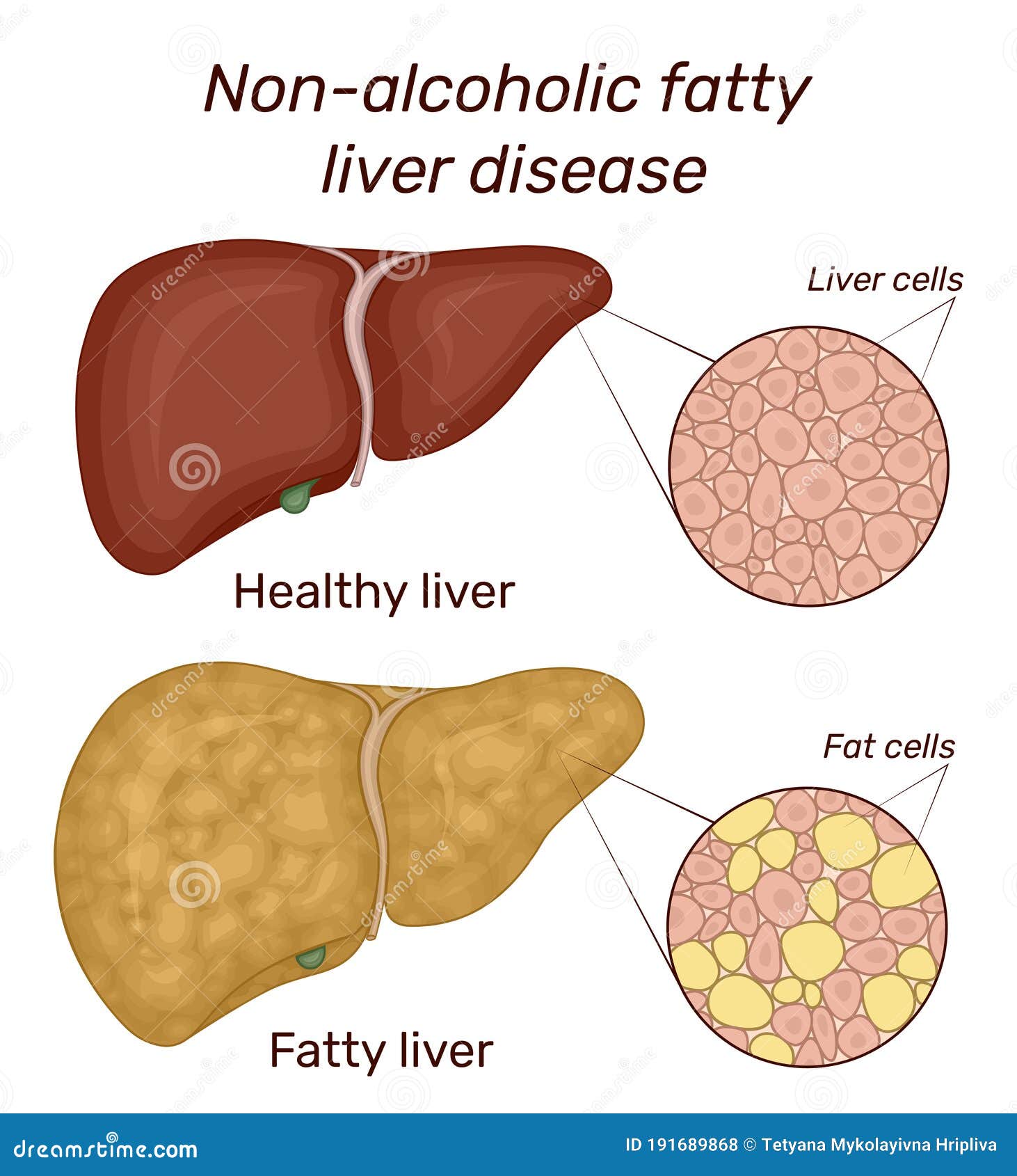 of non-alcoholic fatty liver disease