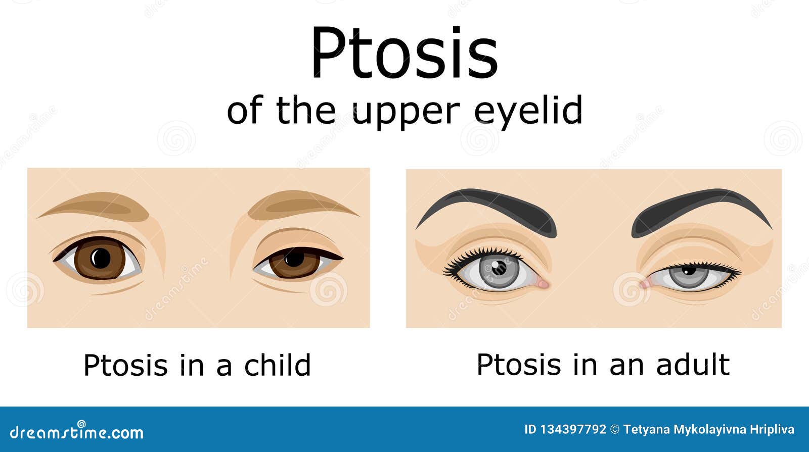 Anatomy Of The Eyelid Eyelid Anatomy Images Stock Photos Vectors | My ...