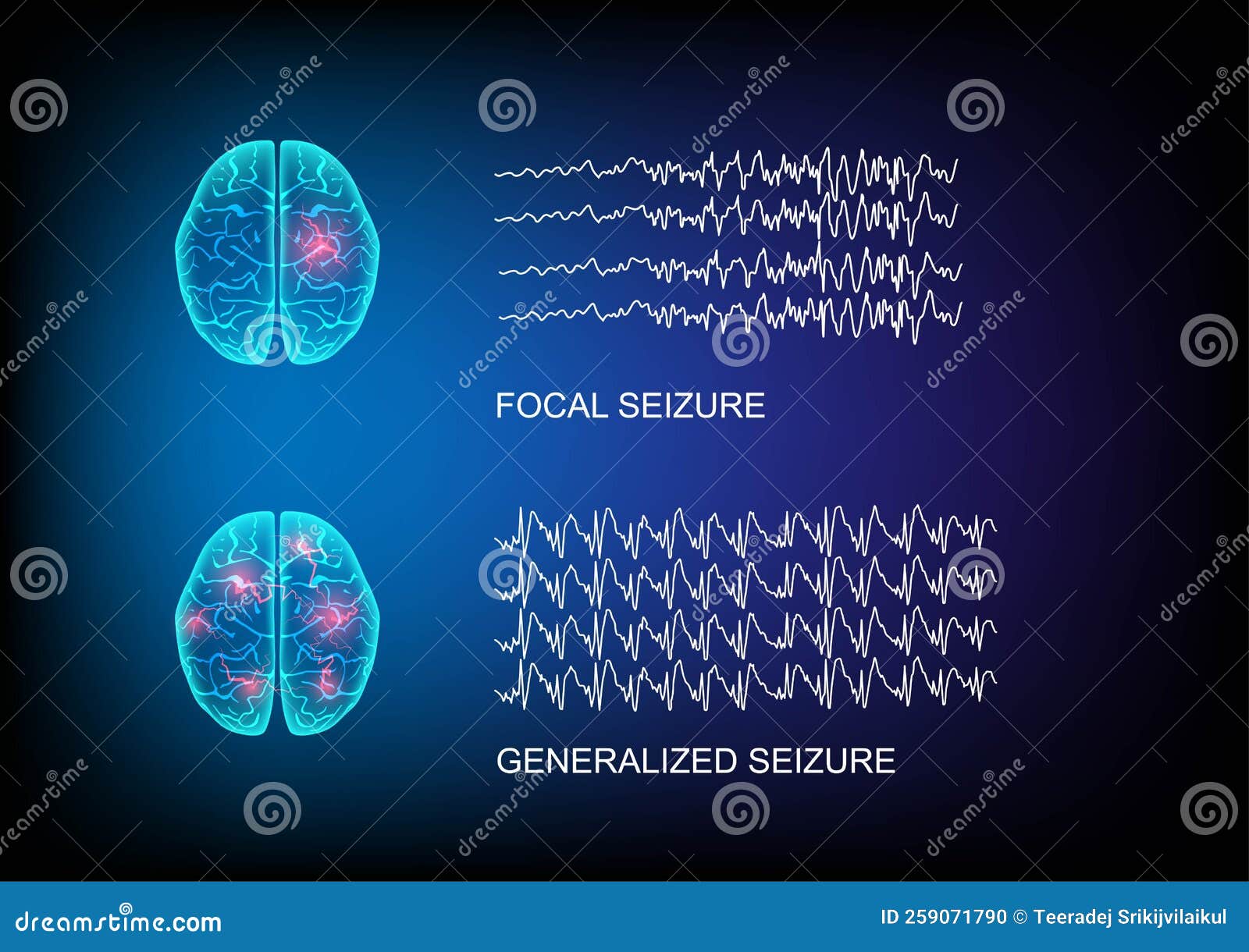 Illustration Of Seizure Types Demonstrating By Onset And Brain Waves