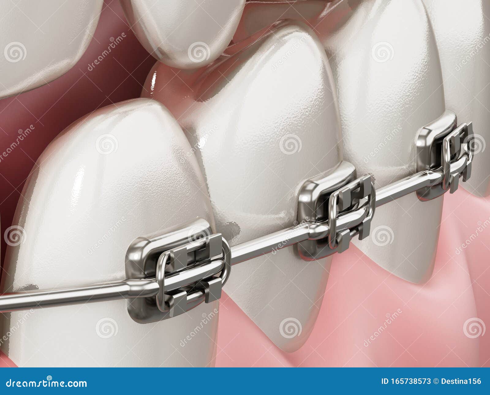 Illustration Showing Dental Braces on Straight Teeth. 3D Illustration Stock Illustration