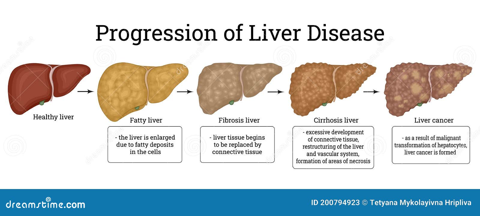 liver damage from sulfasalazine