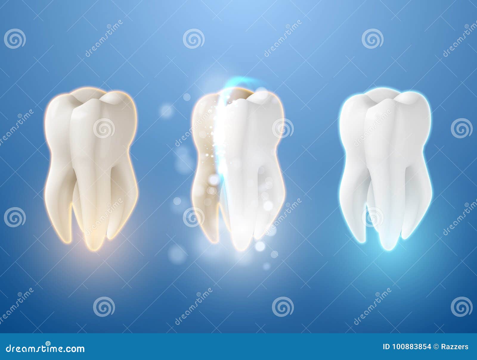 Teeth Whitening System. 3D Realistic Vector Tooth Cleaning Process