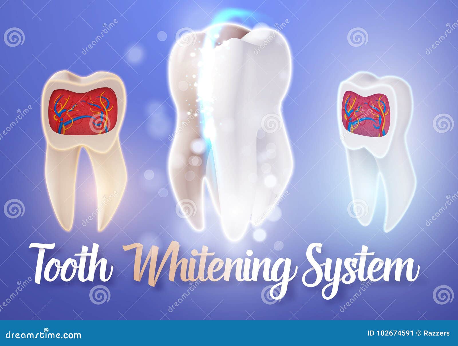 Teeth Whitening System. 3D Realistic Vector Tooth Cleaning Process
