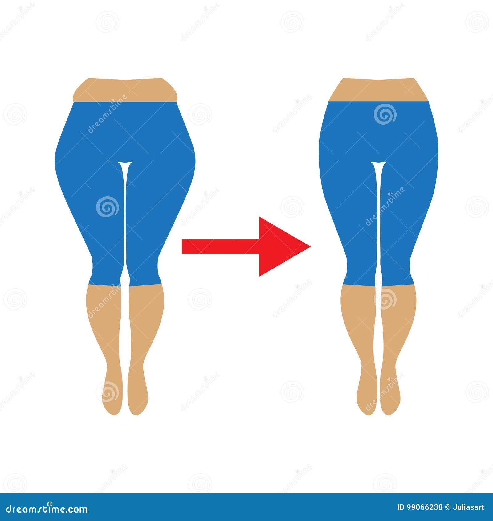 Fat and Slim Womans Hip. Illustration of a Woman with Cellulite Stock  Vector - Illustration of exercise, shape: 99066238