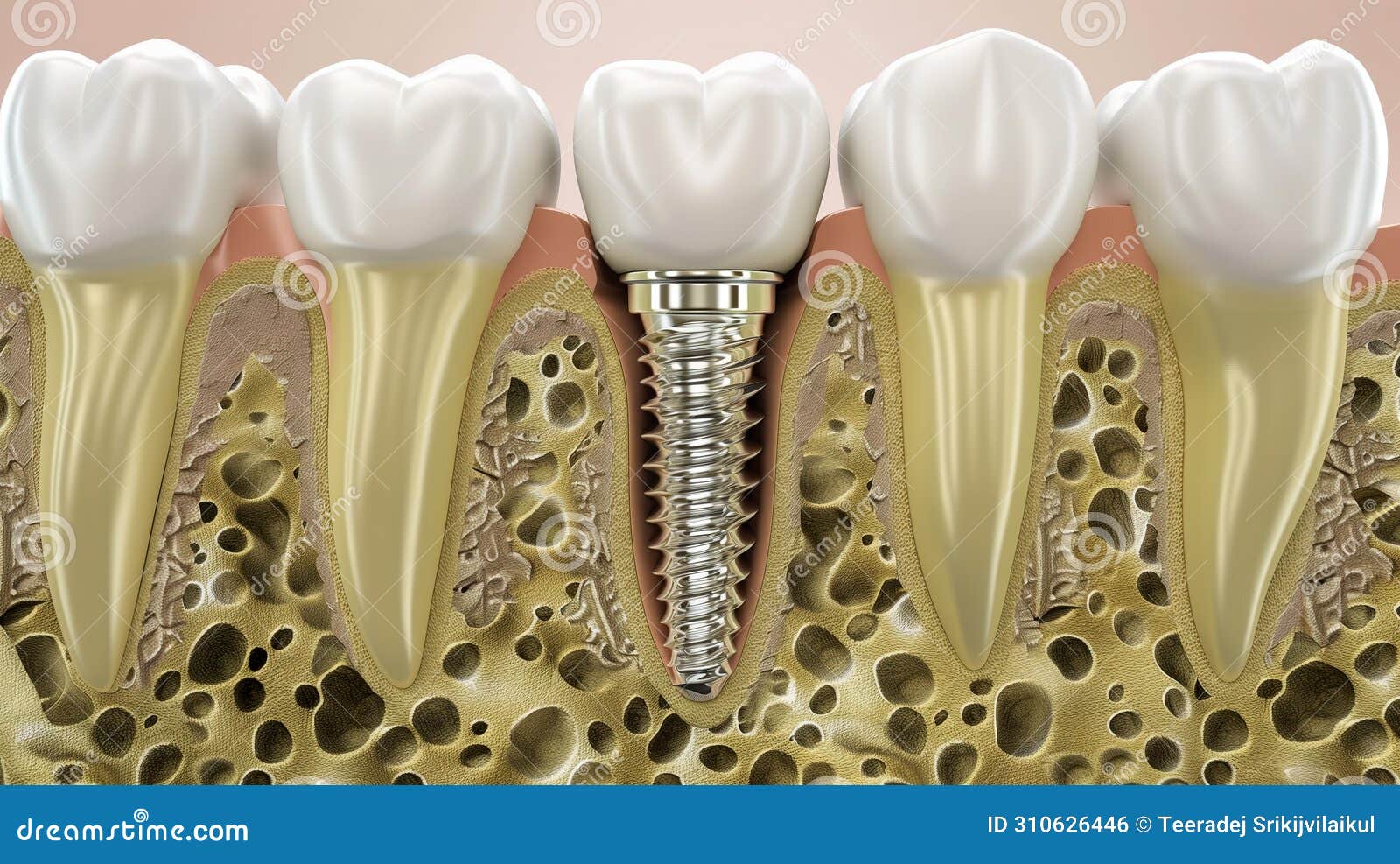 an illustrative cross-section of a dental implant within the jawbone. generative ai