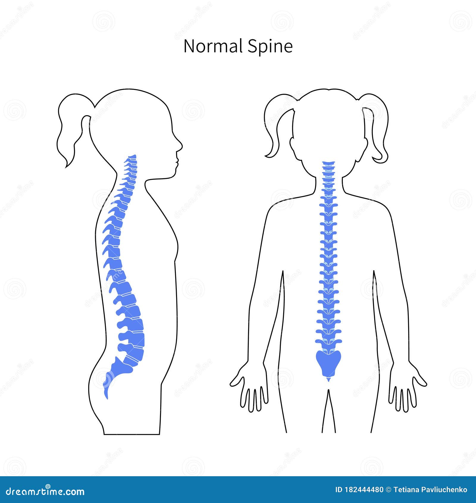 Cirurgia que mudou vida de menina que tinha 'coluna em S' completa