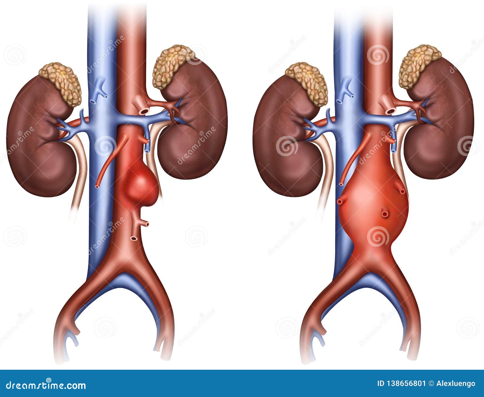 imagen de aneurisma abdominal el aneurisma de aorta abdominal