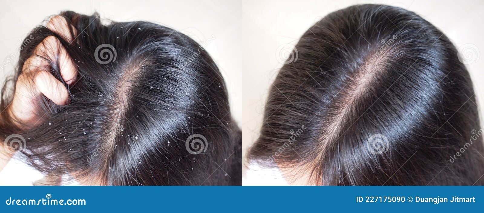 image before and after anti dandruff treatment .