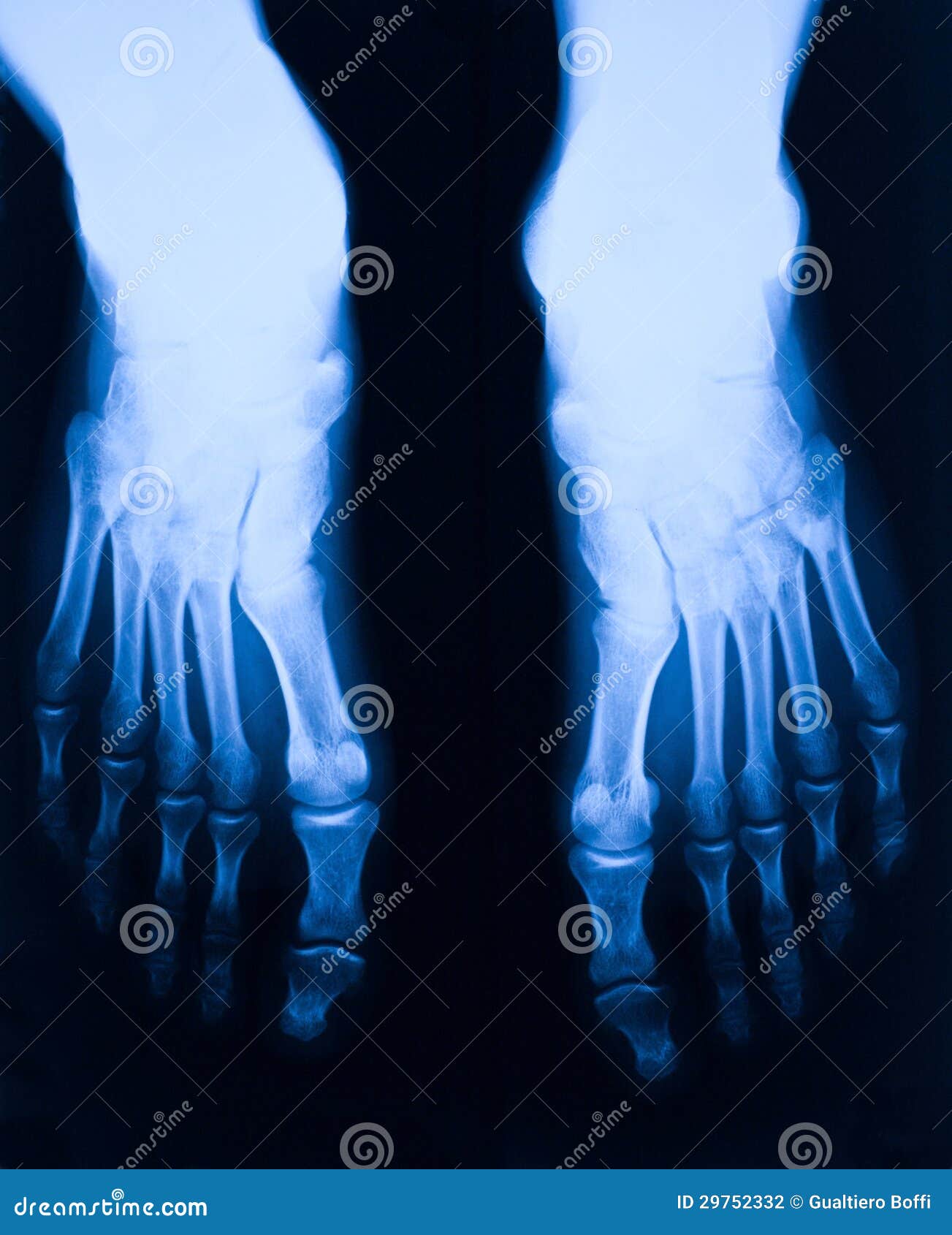 Foot xray stock photo. Image of medicine, skeleton, patient 29752332
