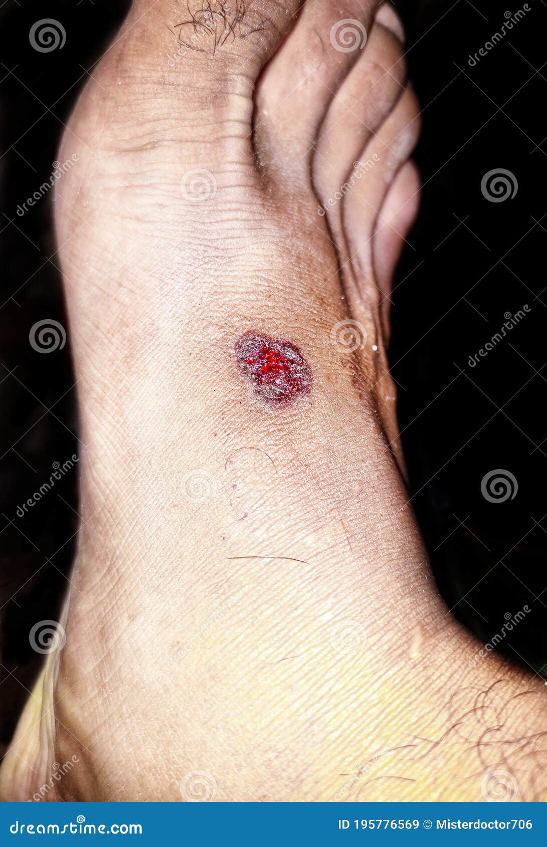 A Healing Wound on Foot after Trauma. Stock Image Image of foot