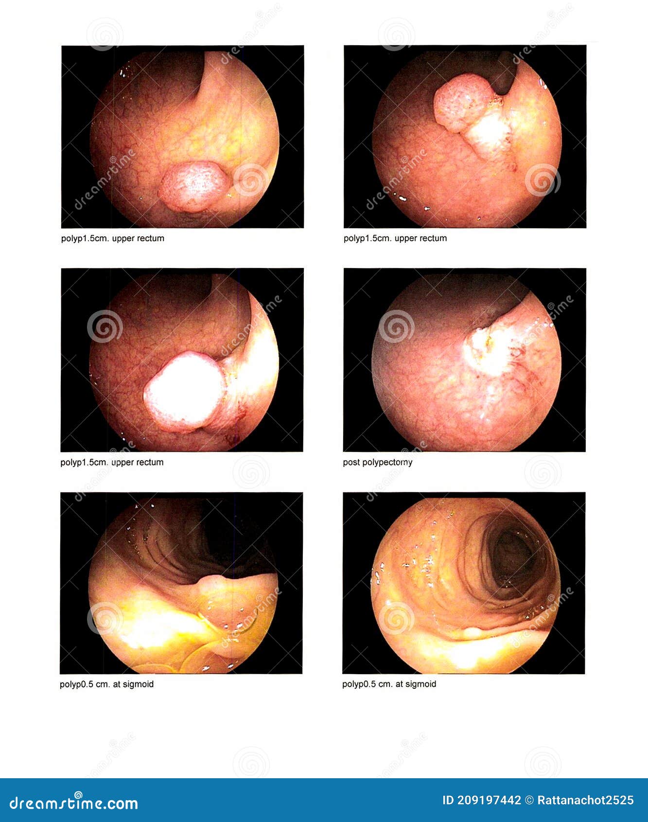 Image Médicale Examen Endoscopique Gastro-intestinal Image Trouver ...