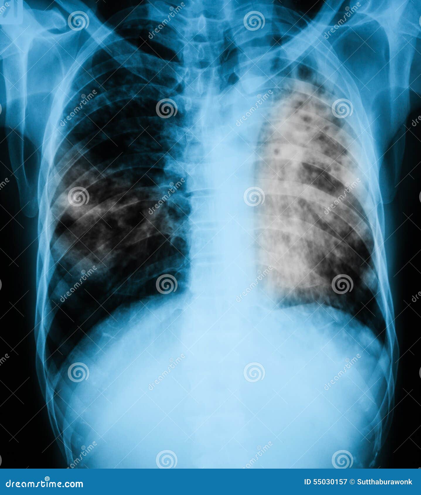 Tuberculose pulmonar — Foto © stockdevil_666 #61325201, image size:1437x1690