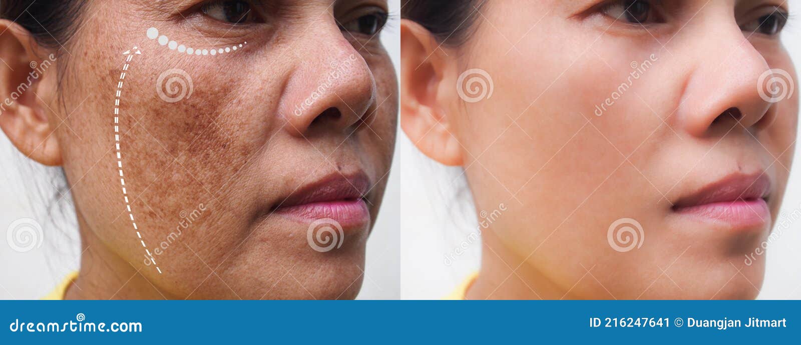Imagen Antes Y Después Del Tratamiento Mancha Oscura Melasma Pigmentación Piel Tratamiento Rejuvenecimiento En La Imagen de archivo - Imagen de poros: