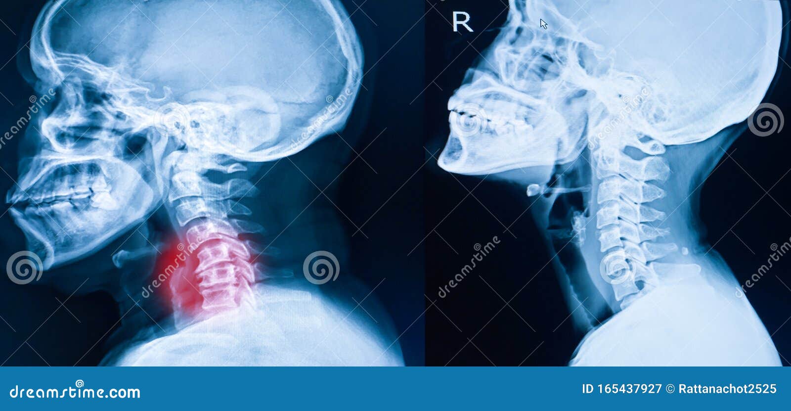 Imagen De Rayos X De La Columna Cervical Imagen De Rayos X Del Cuello