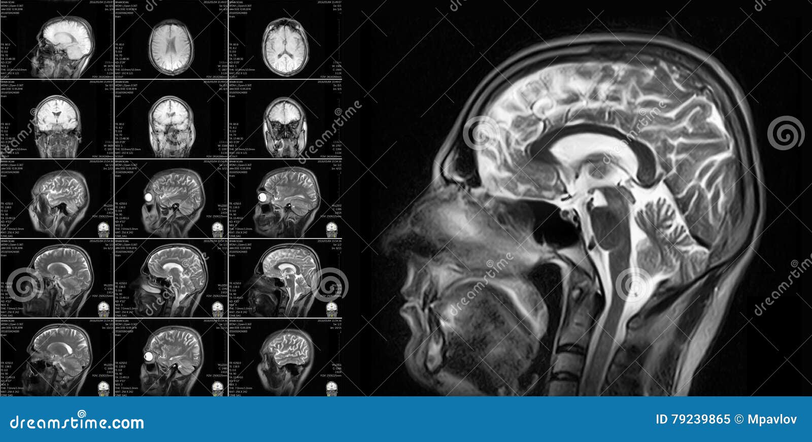 Imaging a Risonanza Magnetica Del Cervello Immagine Stock - Immagine di  diagnosi, cura: 79239865