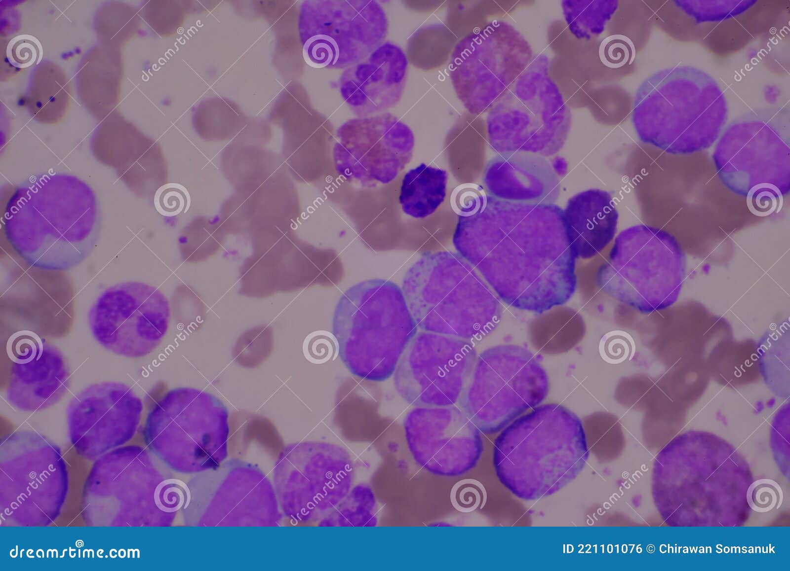 myelocyte and metamyelocyte