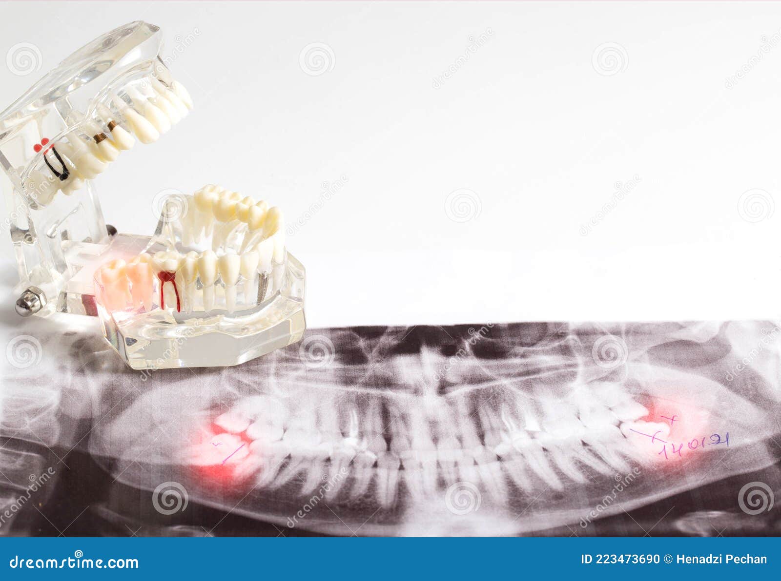 Impacted Wisdom Teeth On An X Ray Picture With An Inflamed Cyst