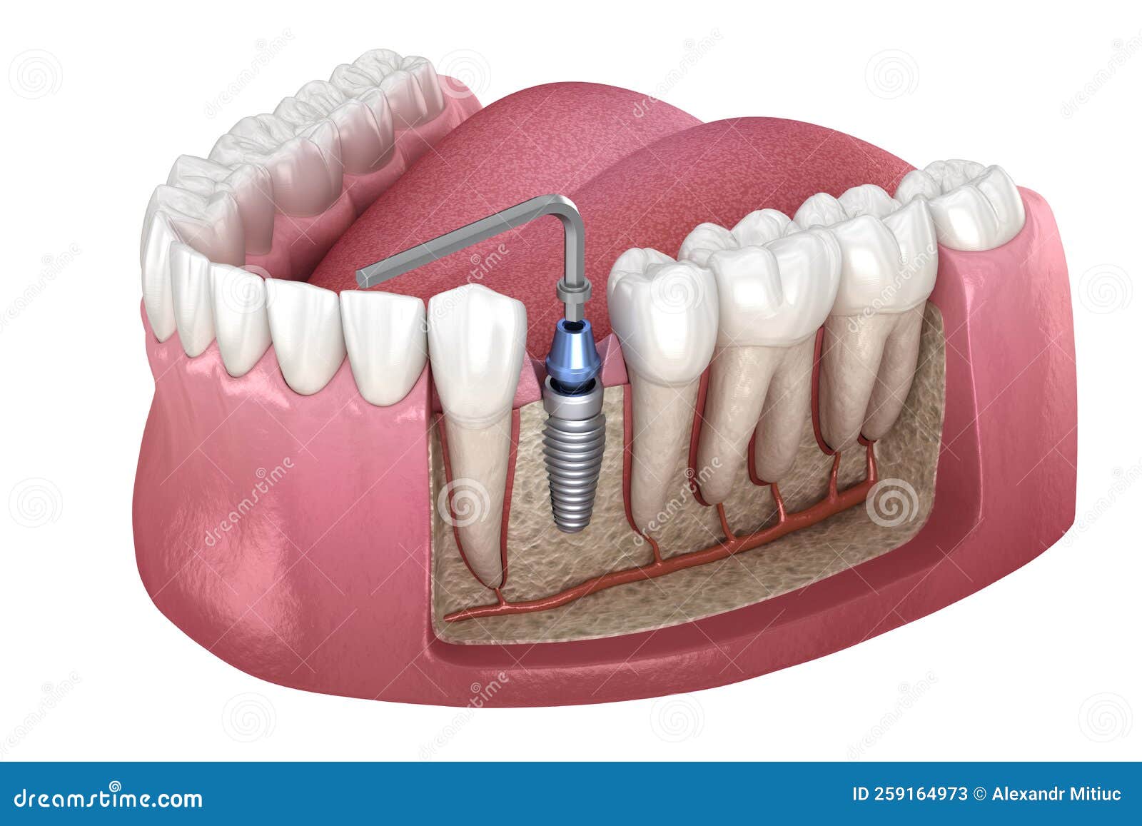 implant abutment fixation procedure. medically accurate 3d  of human teeth and dentures concept