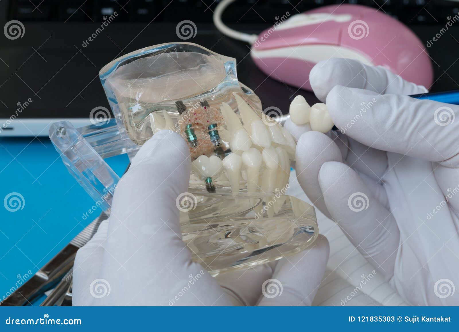Implant and Orthodontic Model. Stock Image Image of dental, mouth 121835303