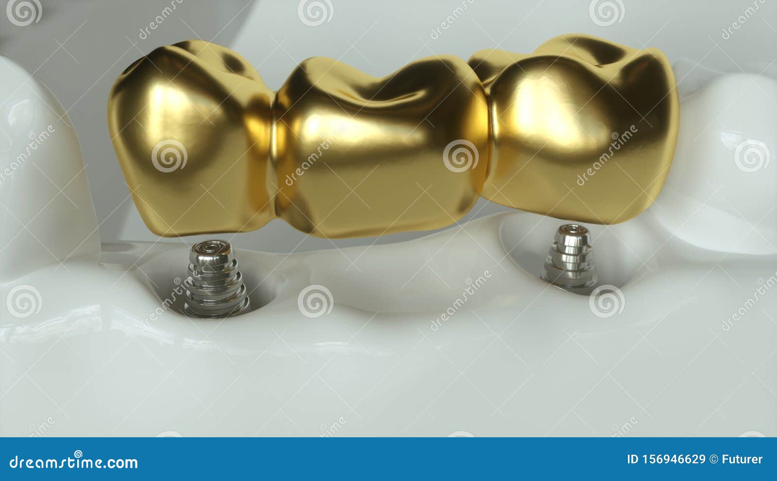 Implants with Golden Dental Bridge 3d Rendering Stock Illustration
