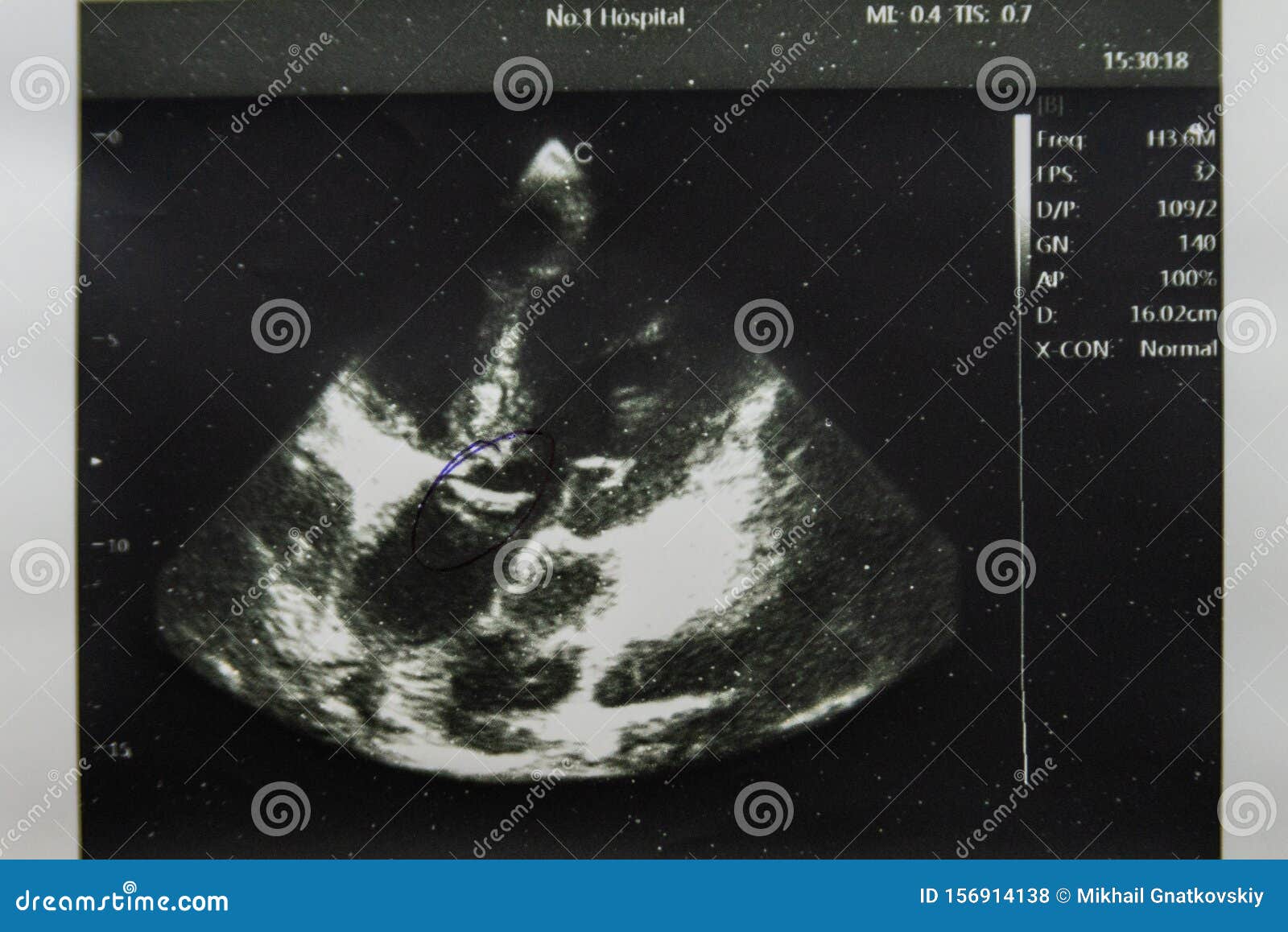 Impression D Une Image D Echographie Du Coeur Sur Papier Photo Stock Image Du Diagnostique Moniteur Impression D Une Image D Echographie Du Coeur Sur Papier Photo Stock Image Du Diagnostique Moniteur