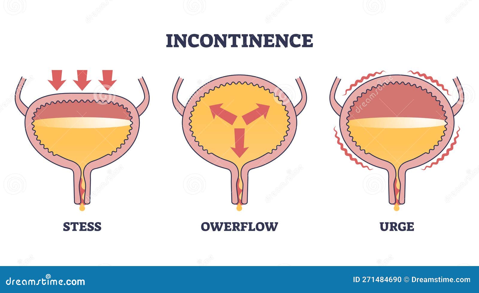 Incontinence Problem With Stress Owerflow And Urge Types Outline incontinence-problem-with-stress-owerflow-and-urge-types-outline