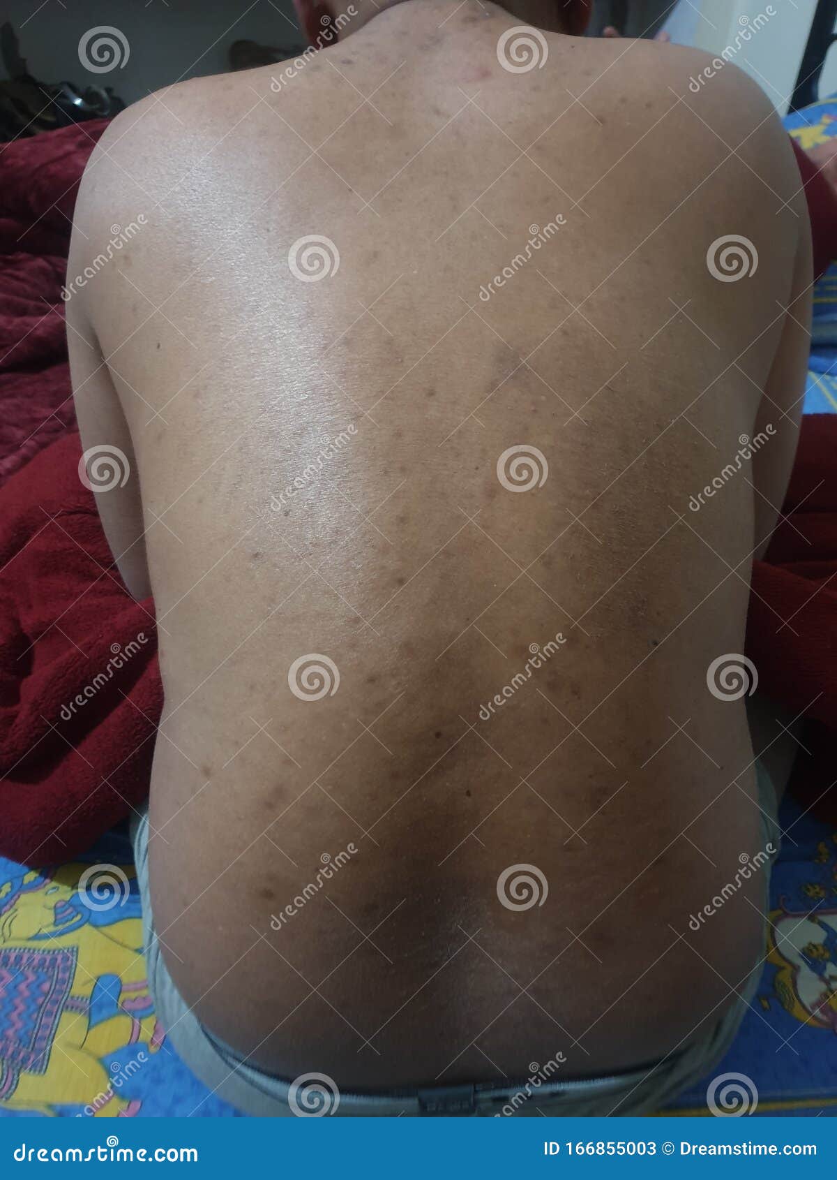 Indian Mosquito Bite a Common Problem Stock Image Image of india