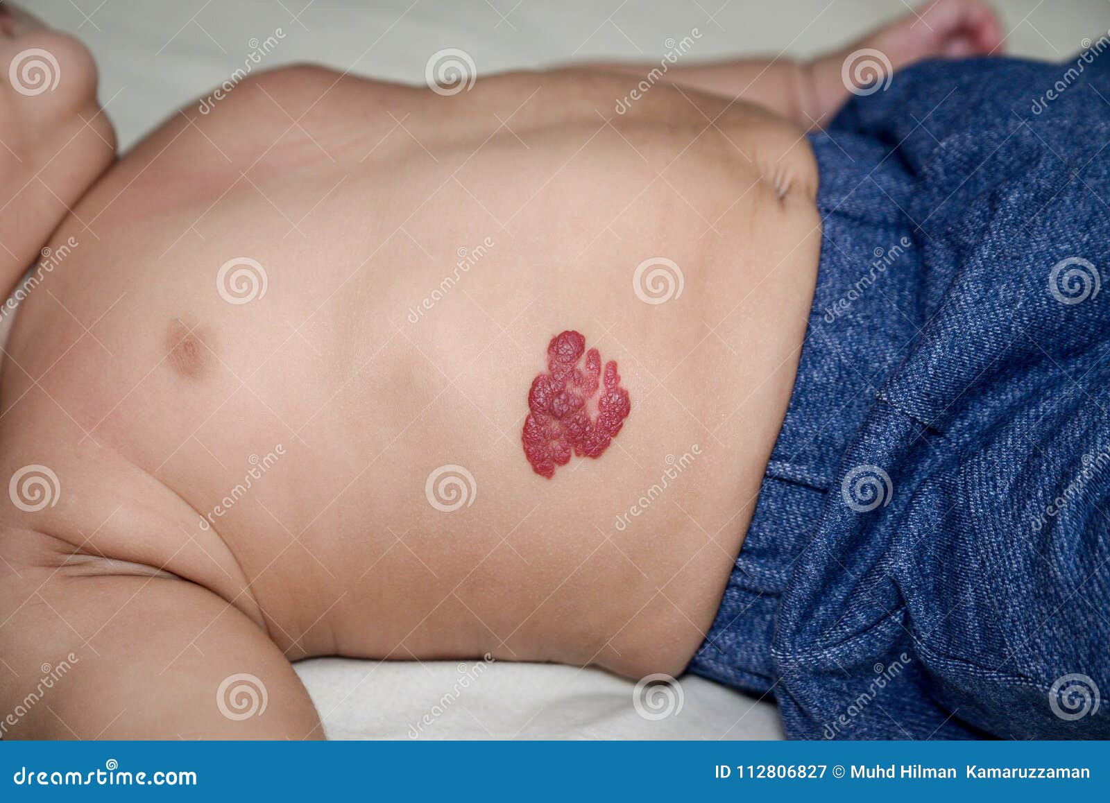 infantile hemangioma red birthmark on the baby`s belly