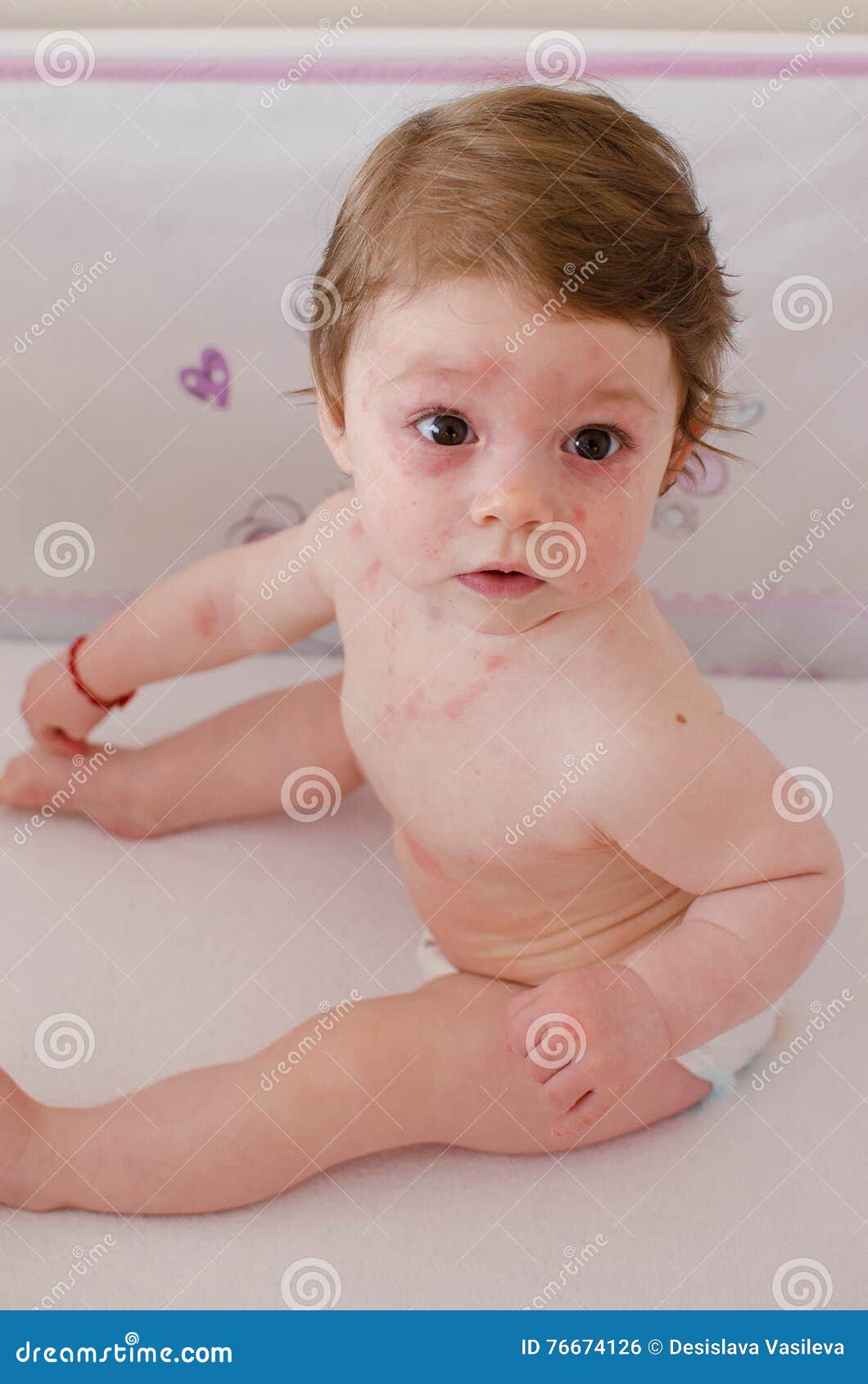 Infantum De Roseola Foto De Stock Imagem De Corpo Herpes