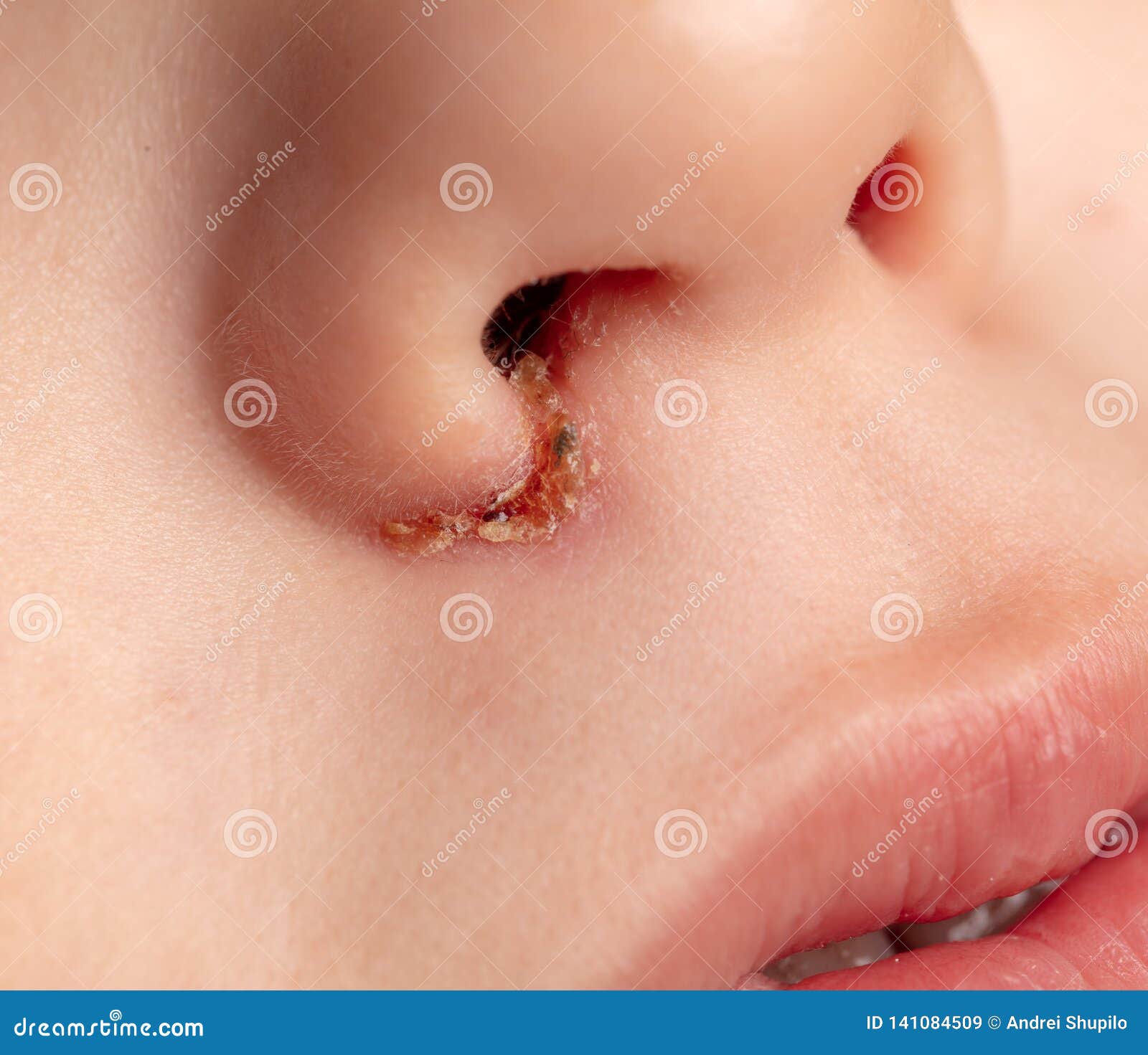 Infecção No Nariz Da Criança Imagem de Stock - Imagem de menina, fundo:  141084509, image size:1600x1471