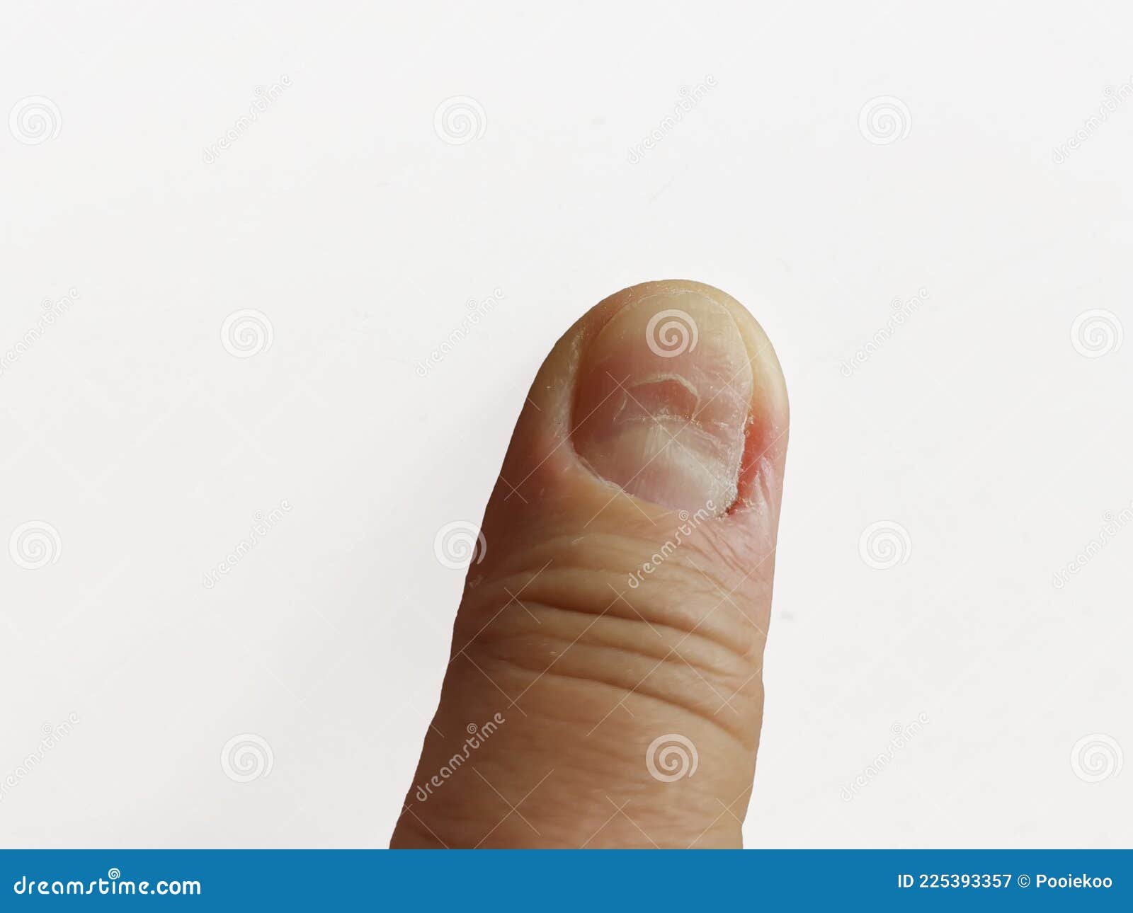 Nail Fungus Infection Image & Photo (Free Trial) | Bigstock