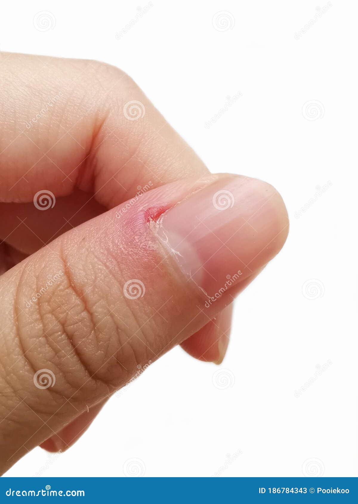 Close Up of Nail Fungus Infection on the Thumb Finger Stock Image - Image  of healthcare, infected: 131529187