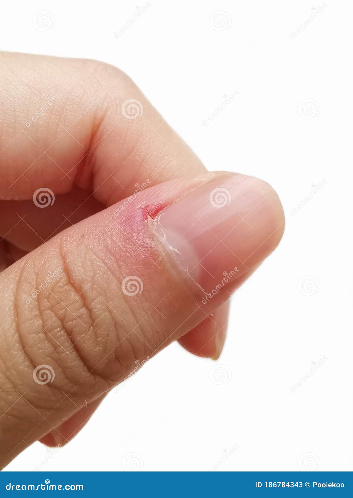 Big Close Up Of Fungus Infection On Nails Hand Finger With Onychomycosis  Fungal Infection On Nails Stock Photo - Download Image Now - iStock