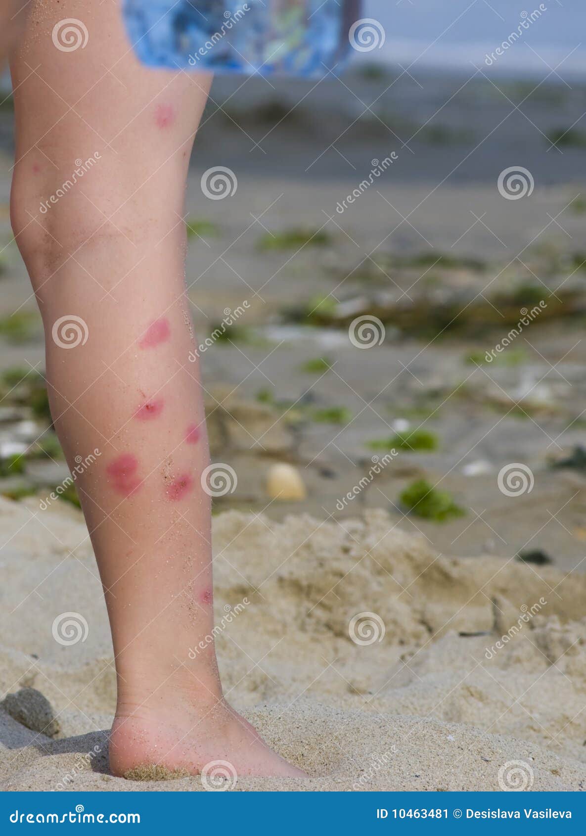 Infected Skin From A Mosquito Stock Image Image Of Child Irritation