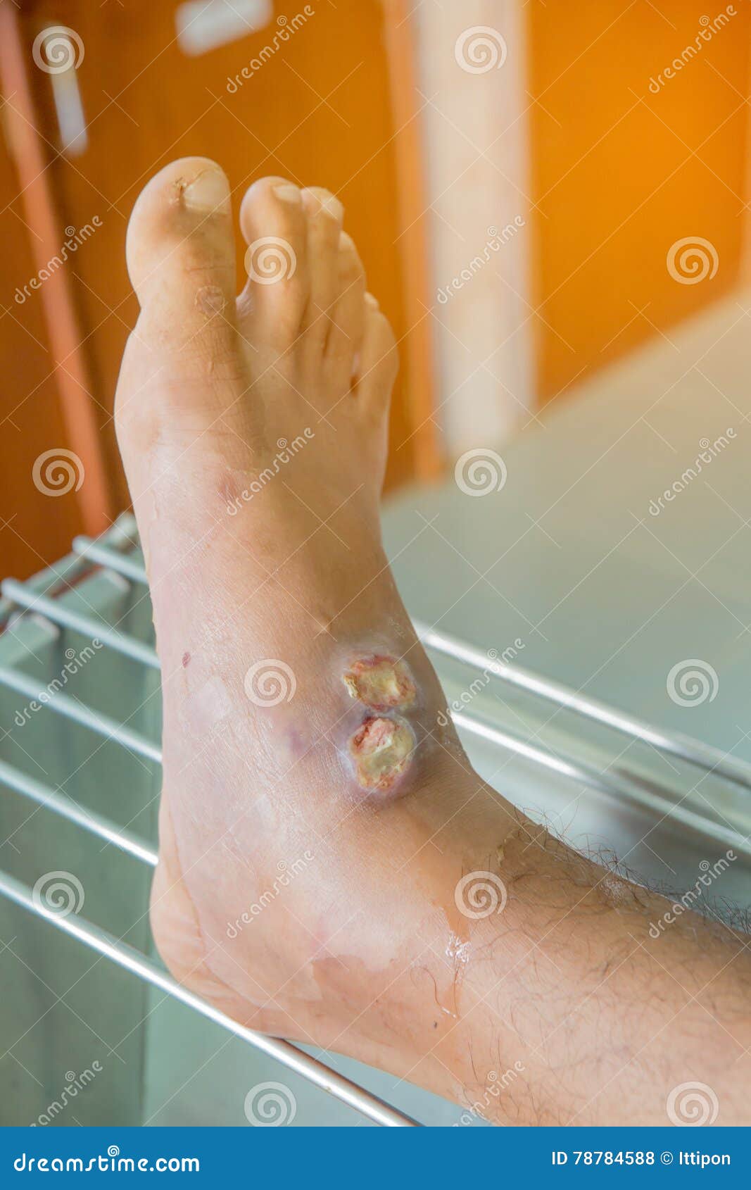 Infected wound stock photo. Image of foot, body, medical 78784588