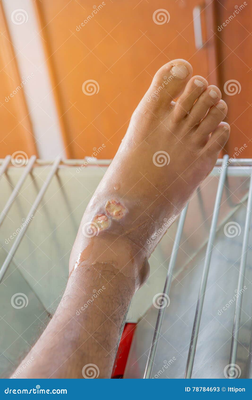 Infected wound stock image. Image of injury, amputation 78784693