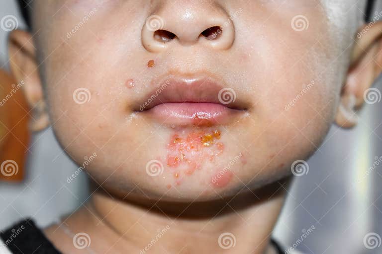 Infection Cutanée Staphylococcique Appelée Impetigo Autour De La Bouche