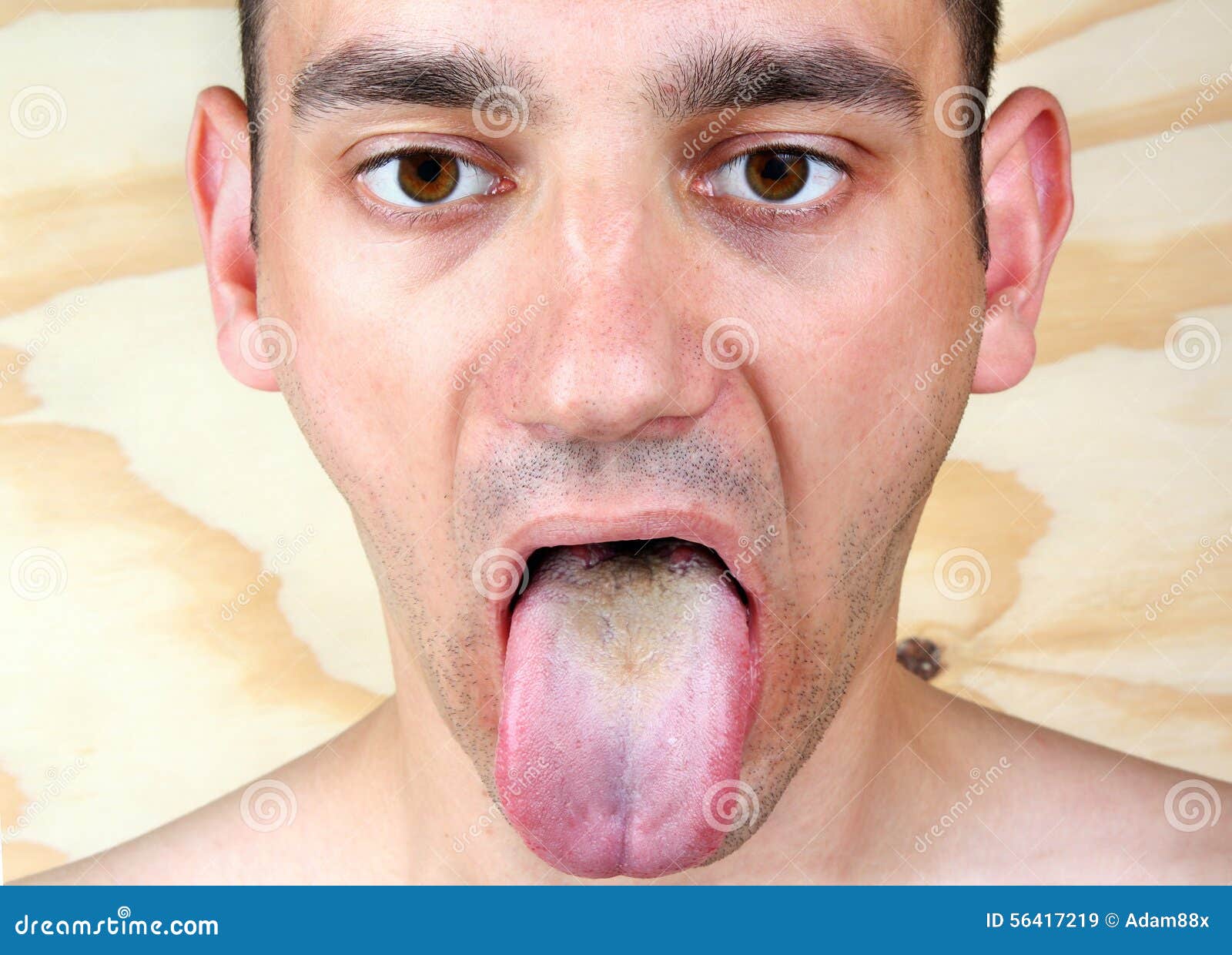 Infection Tongue Stock Photo - Image: 564172191300 x 1024