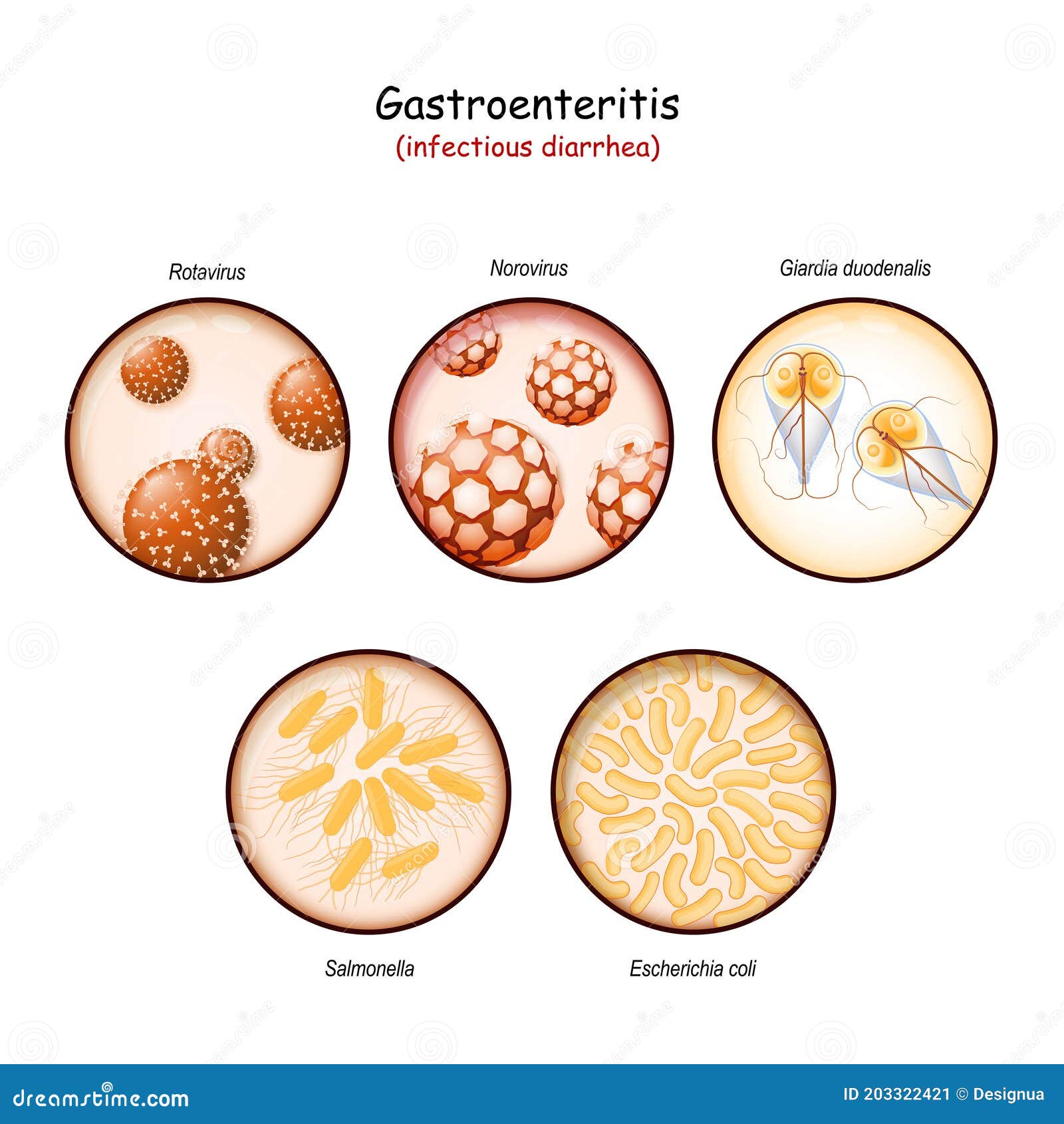 giardia vs gastroenteritis