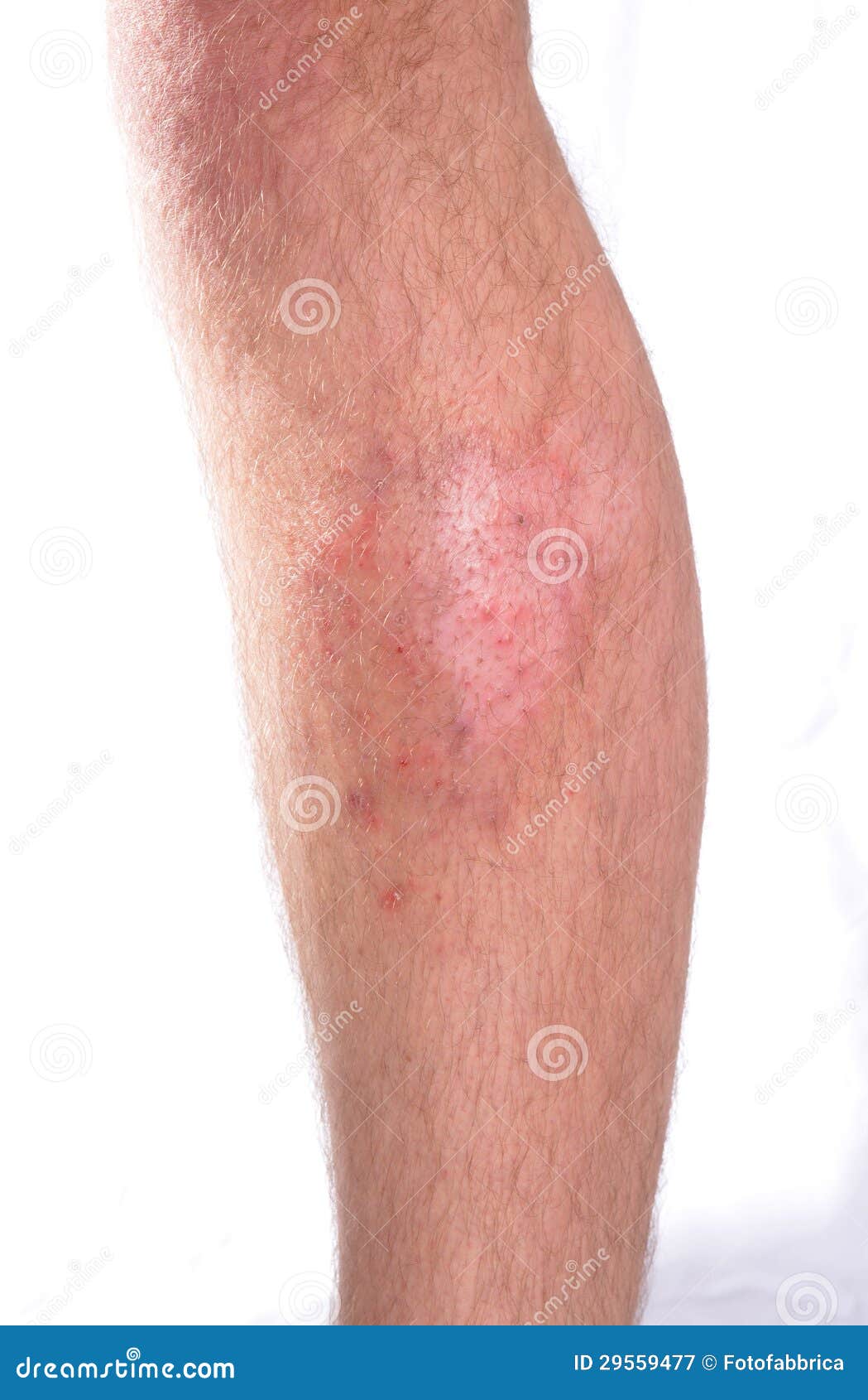 Infezione della pelle immagine stock. Immagine di medico 29559477