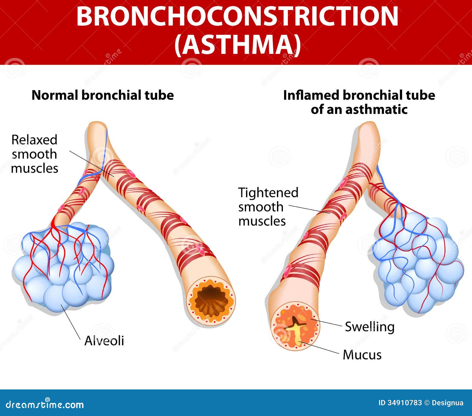 inflamation of the bronchus causing asthma