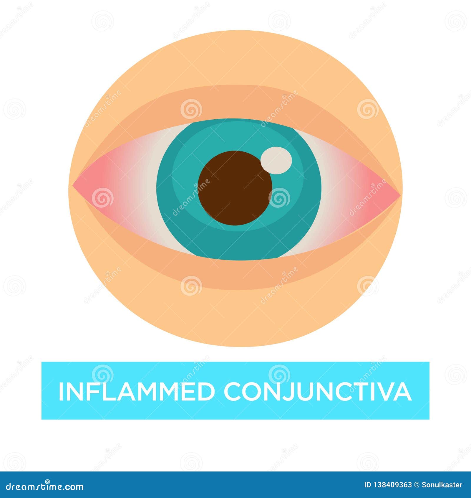 inflamed conjunctiva conjuntivitis sore eye medicine and health