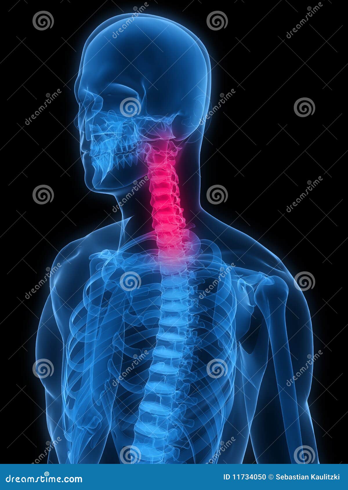 Inflamed neck stock illustration. Illustration of spinal - 11734050