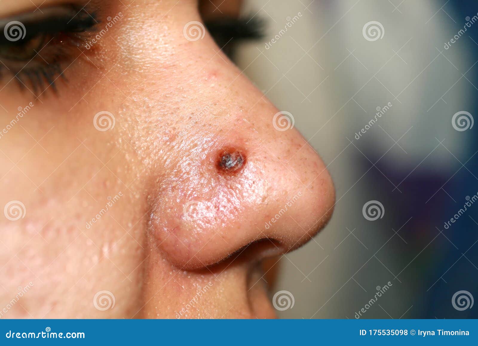 acne cyst nose
