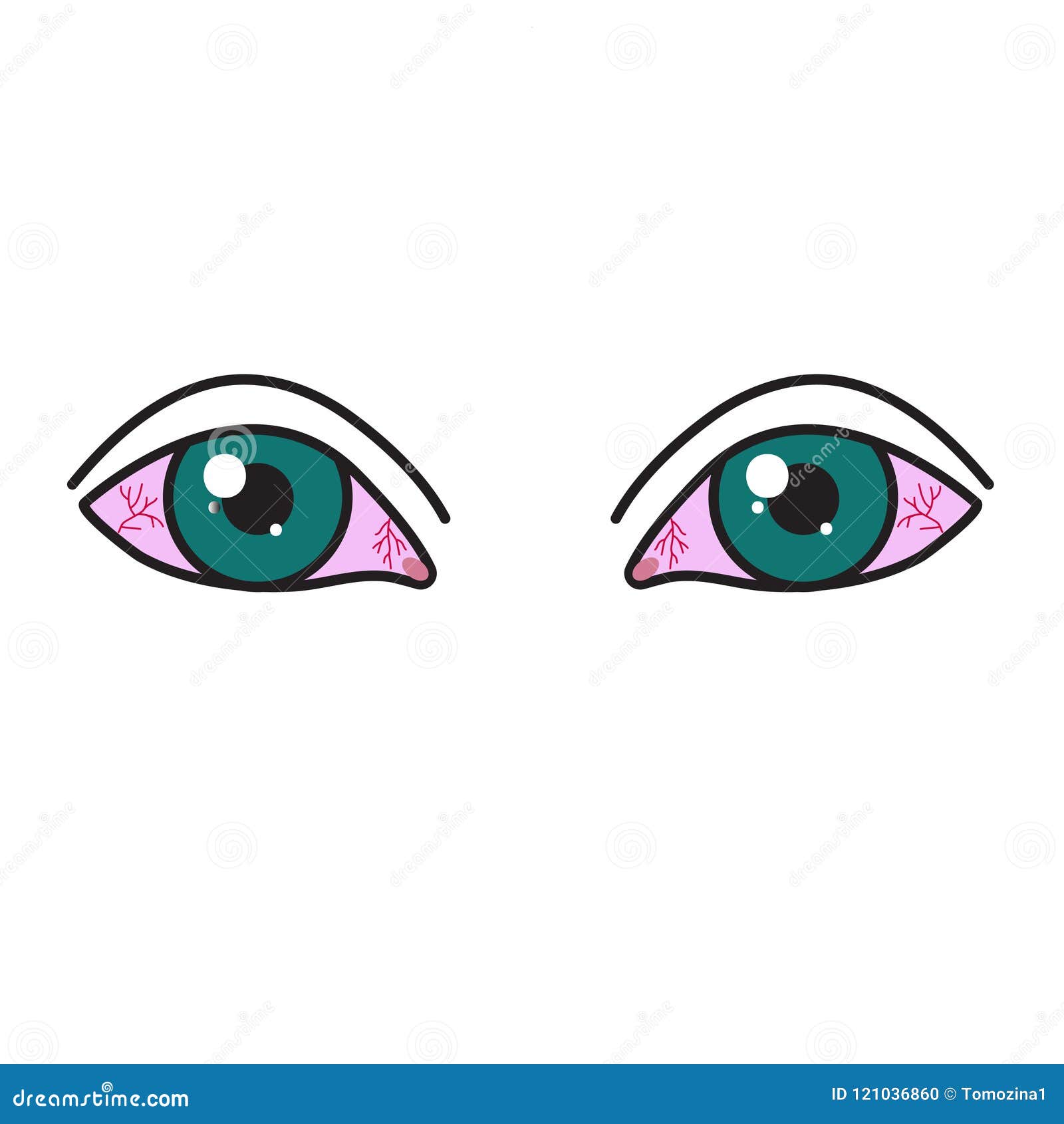 Eye Irritation. Inflamed Bloodshot Eyeball With Red Conjunctiva