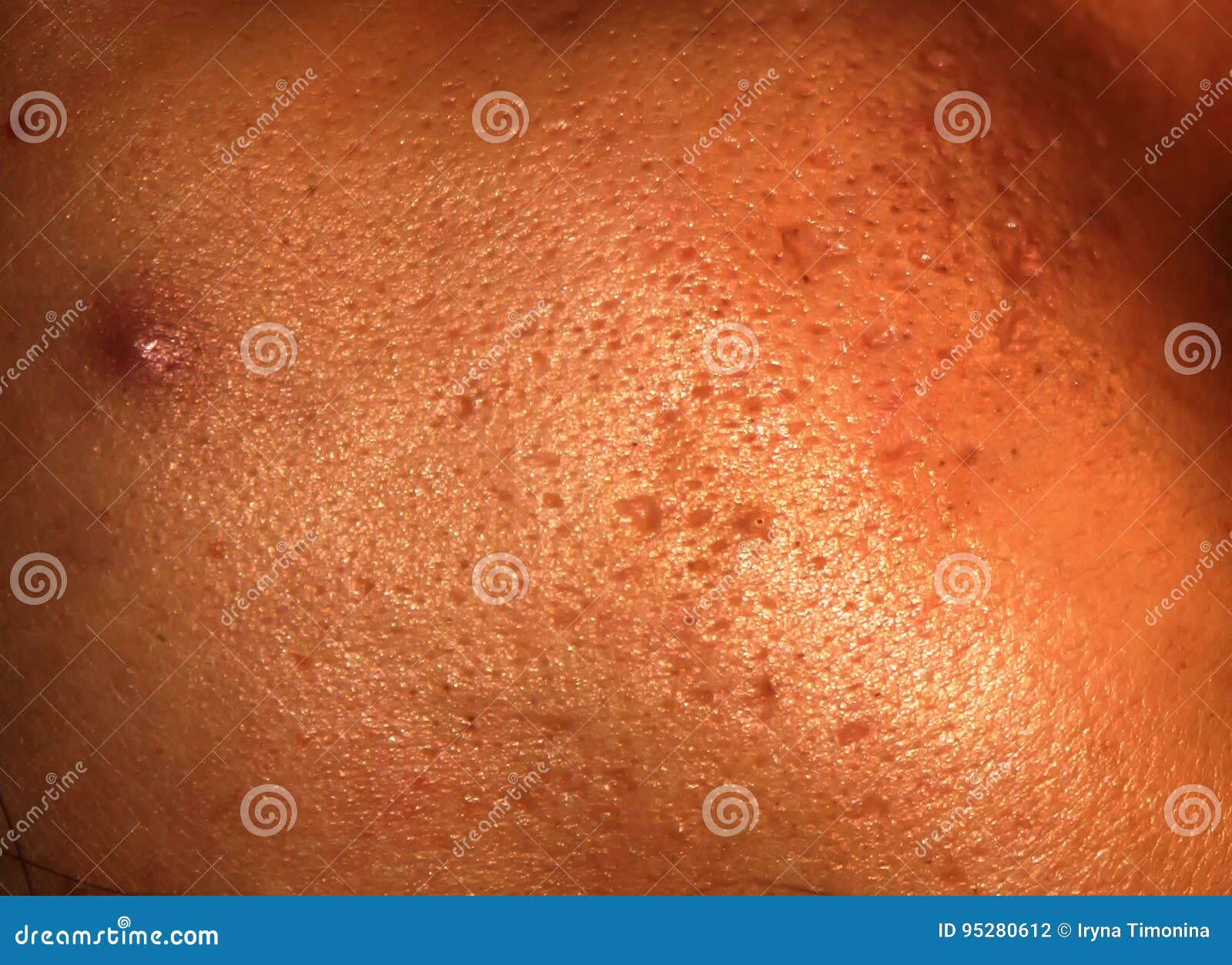 Inflamed Skin Of The Face In Pimples And Acne Keloid Scars From Acne