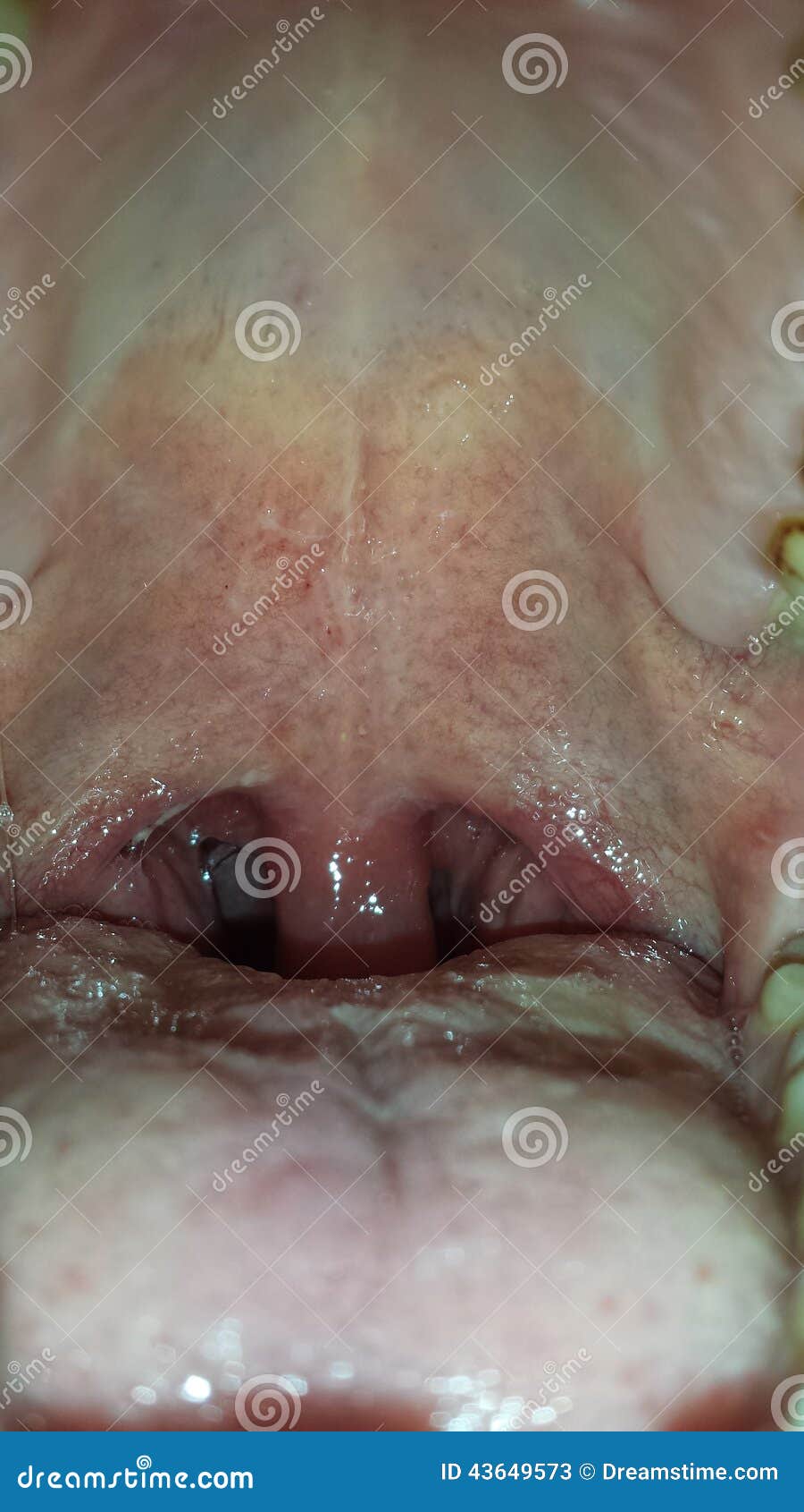 Inflamed uvula stock image. Image of uvula, inflamed 43649573