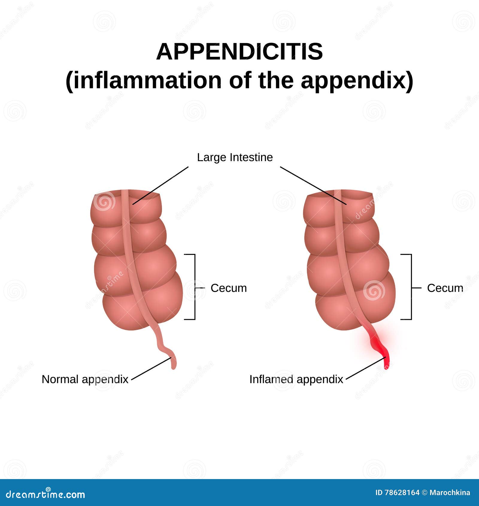 Appendix Diagram